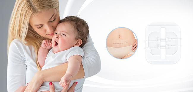 Flexible Fabric Bandages Wound Closure Device 2 / 4 / 6PCS 2